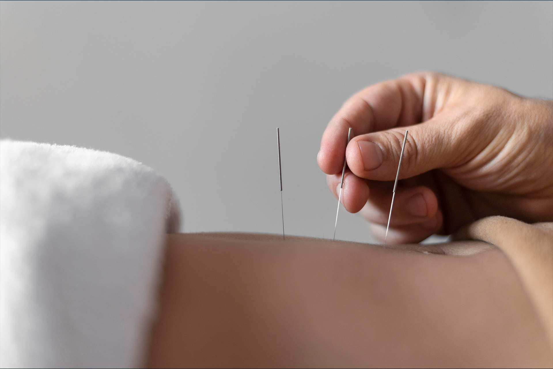 Acupunture